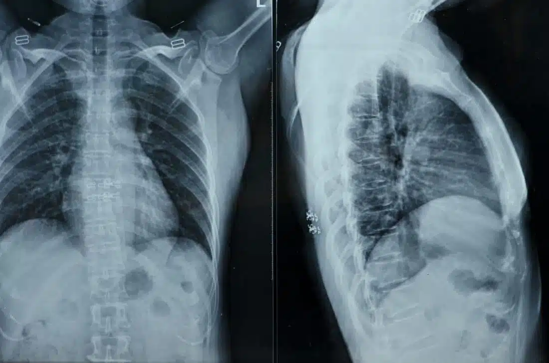 Interesting X-Ray film of female chest