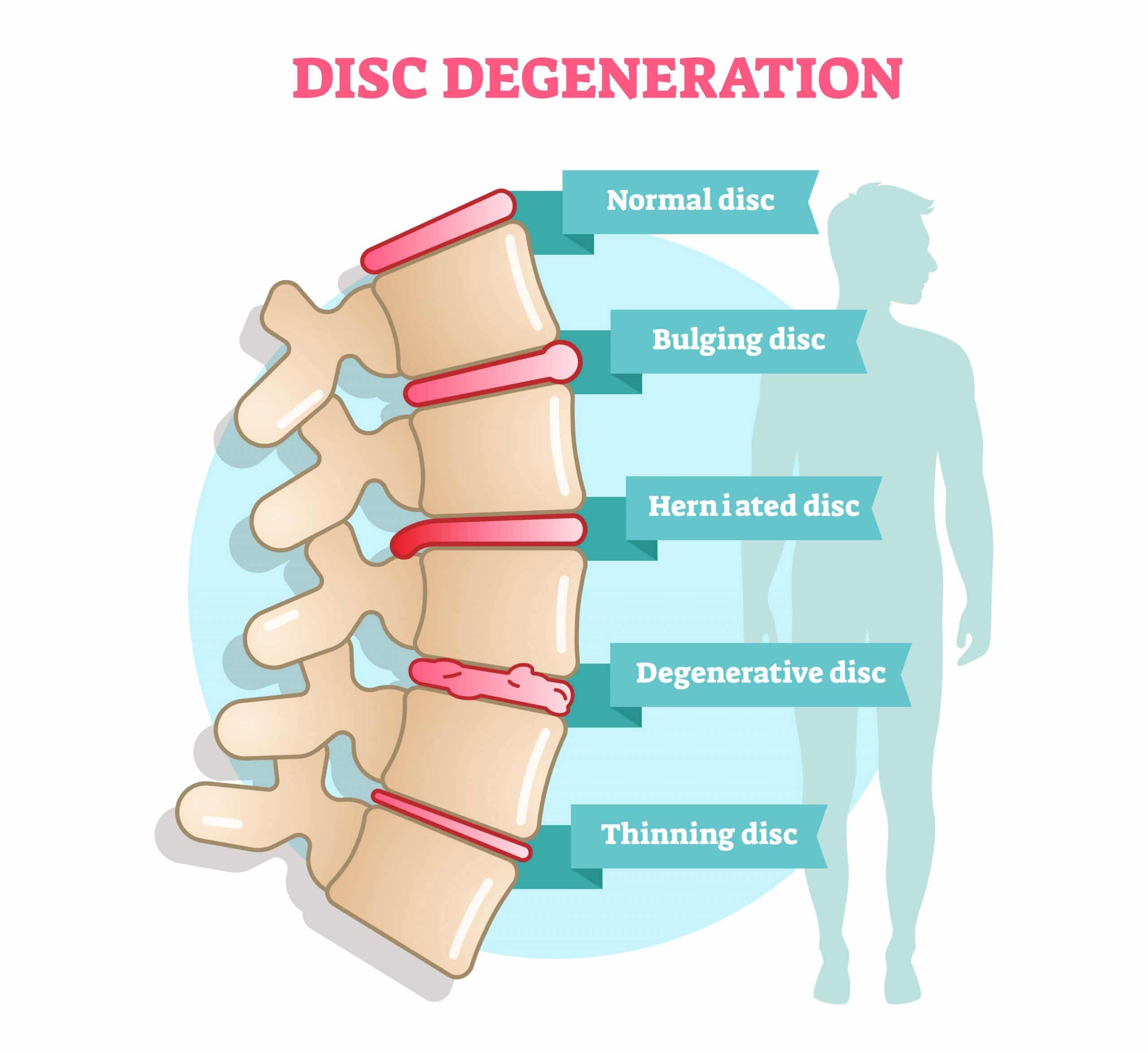 Herniated Discs Treatment In The Woodlands