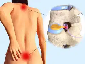 Graphic illustration of back pain and neck pain