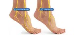 Image showing the the nerve paths in the foot