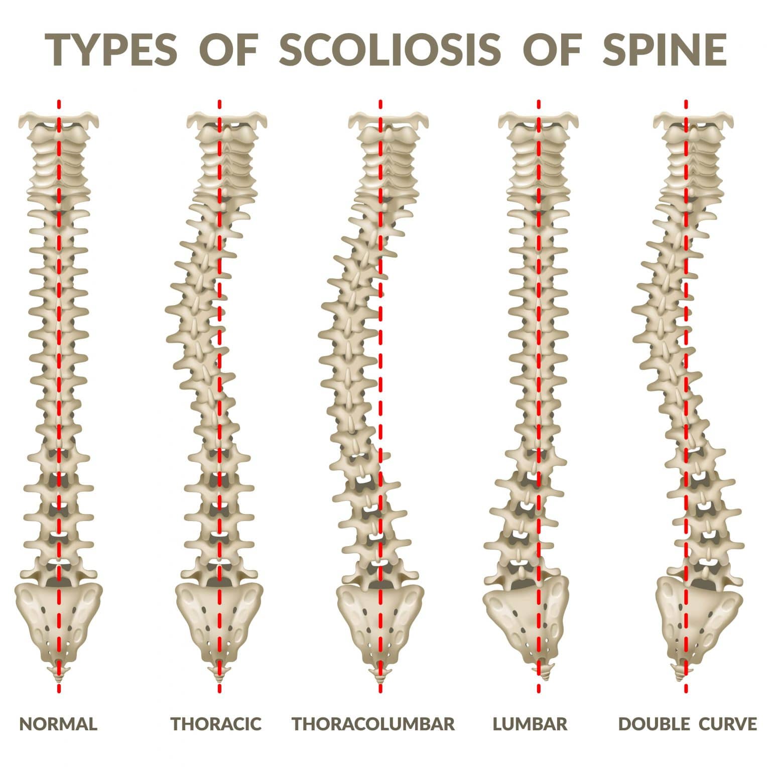 Comprehensive Guide To Understanding Scoliosis In Houston Tx 3994