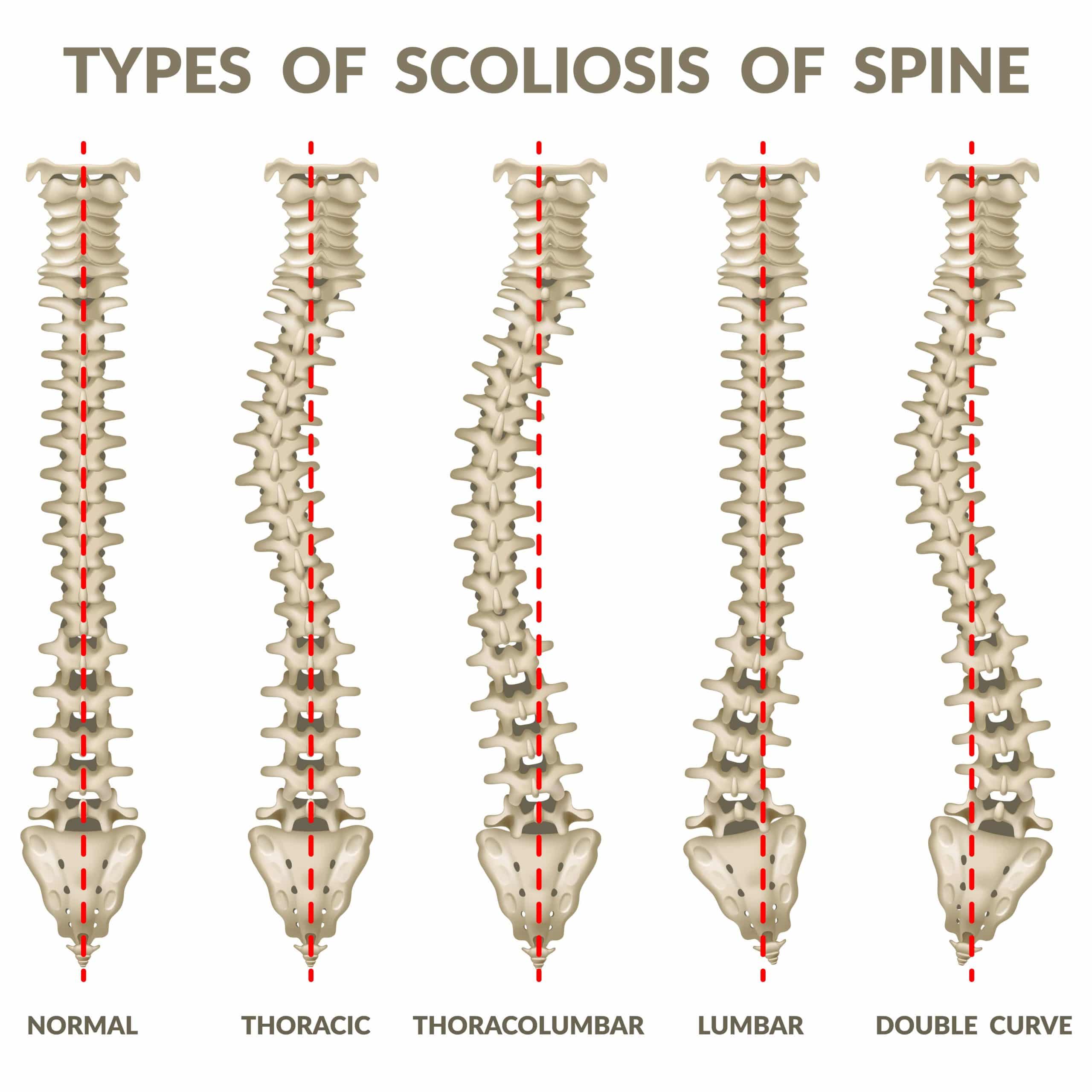 What is the difference between scoliosis and levoscoliosis?