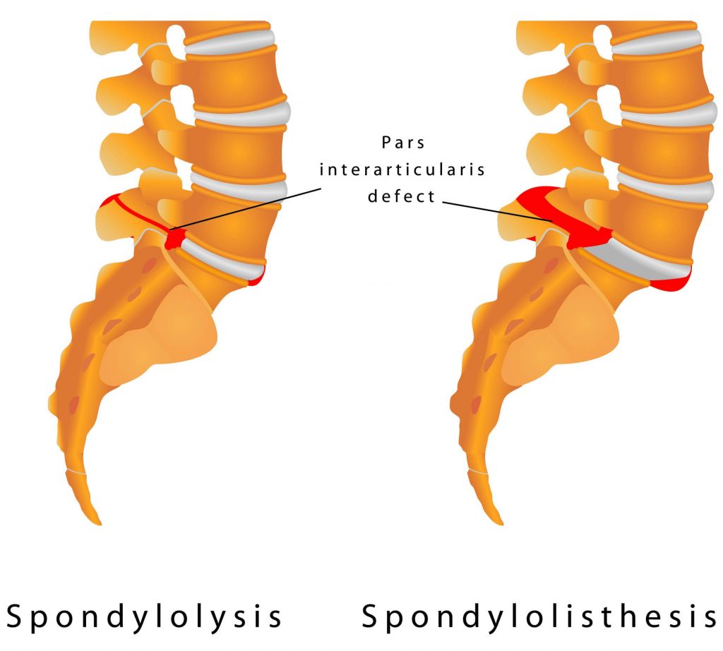 Herniated Discs Treatment In The Woodlands