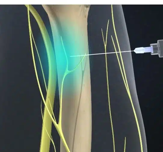 animated representation of nerve blocking 