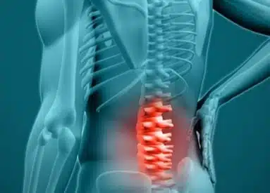 An X-ray picture having a herniated disc syndrome