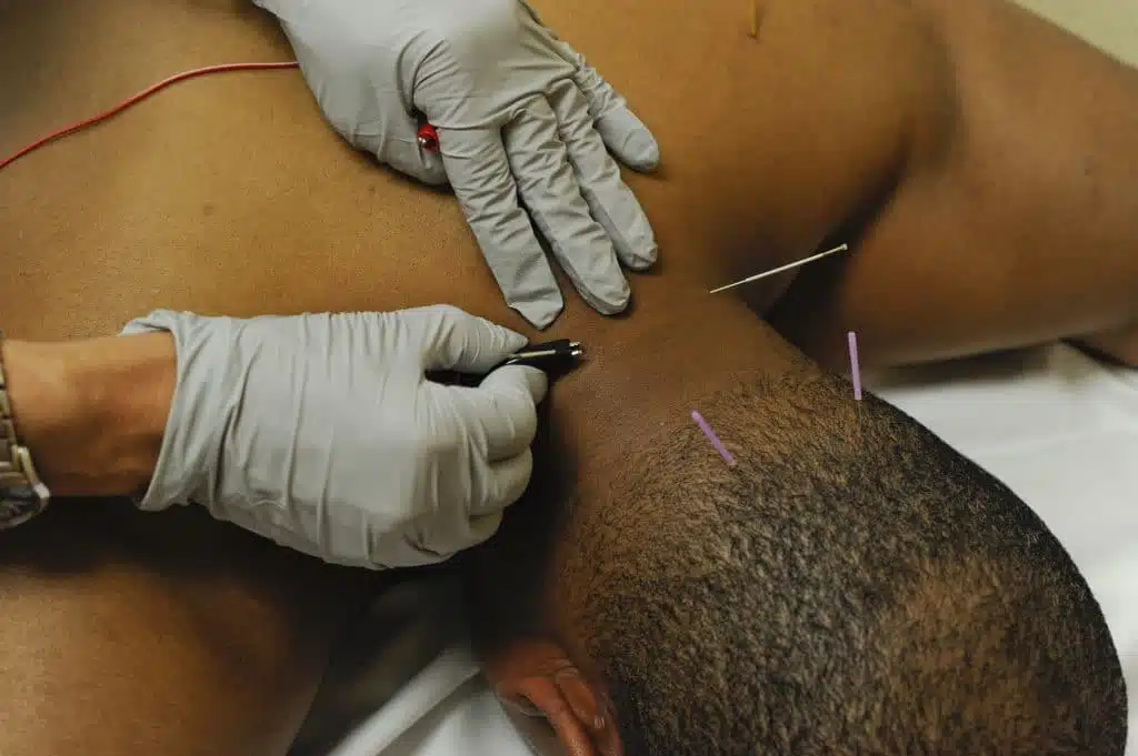 back of an African-American man undergoing dry needling