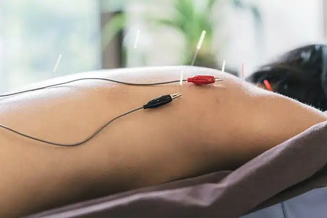 back of a man getting dry needling therapy that uses electrical stimulation