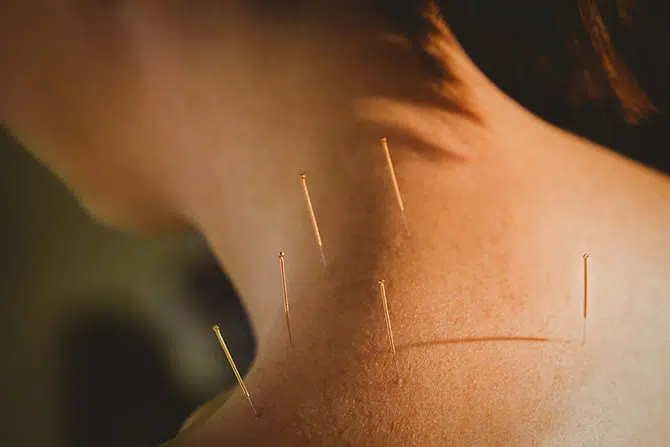 dry needling for shoulder pain