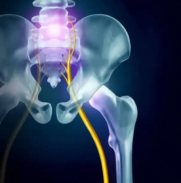 Diagram shows the Sciatica nerve anatomical position | HSRC